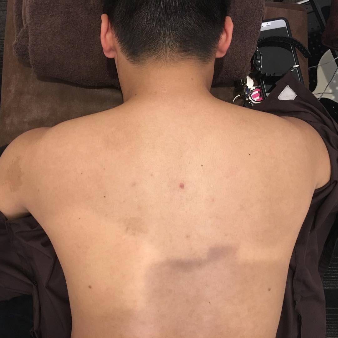 今日は肩こりに悩まれる30代男性の施術例です！